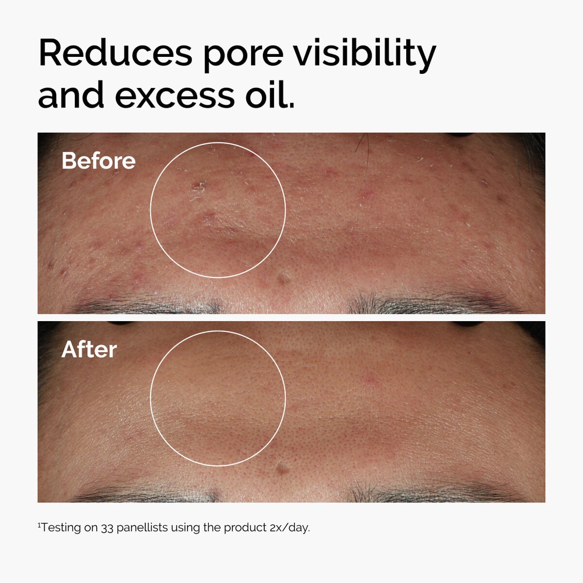niacinamide-10-zinc-1-h2 ord-niacinamide-zinc-blemish-serum-before-after-pores.jpg