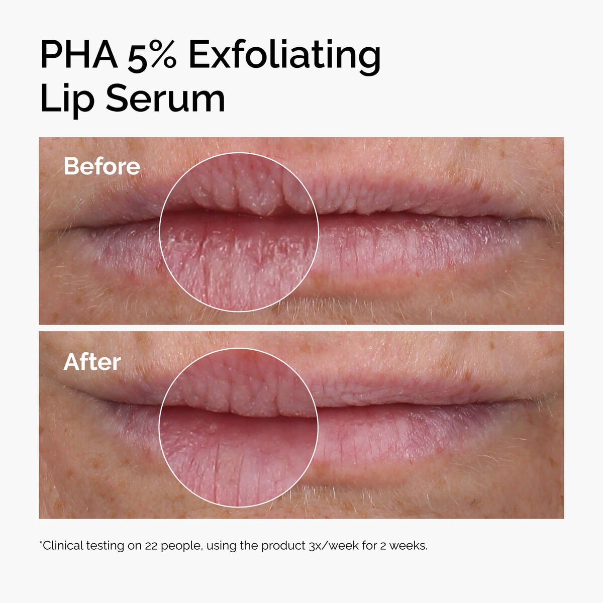 pha-5-exfoliating-lip-serum-q7 ord-pha-5pct-lip-exfoliating-serum-before-after.jpg