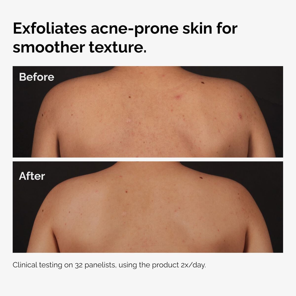 salicylic-acid-0-5-body-serum-l5 ord-salicylic-acid-body-serum-before-after-graphic-NA.jpg