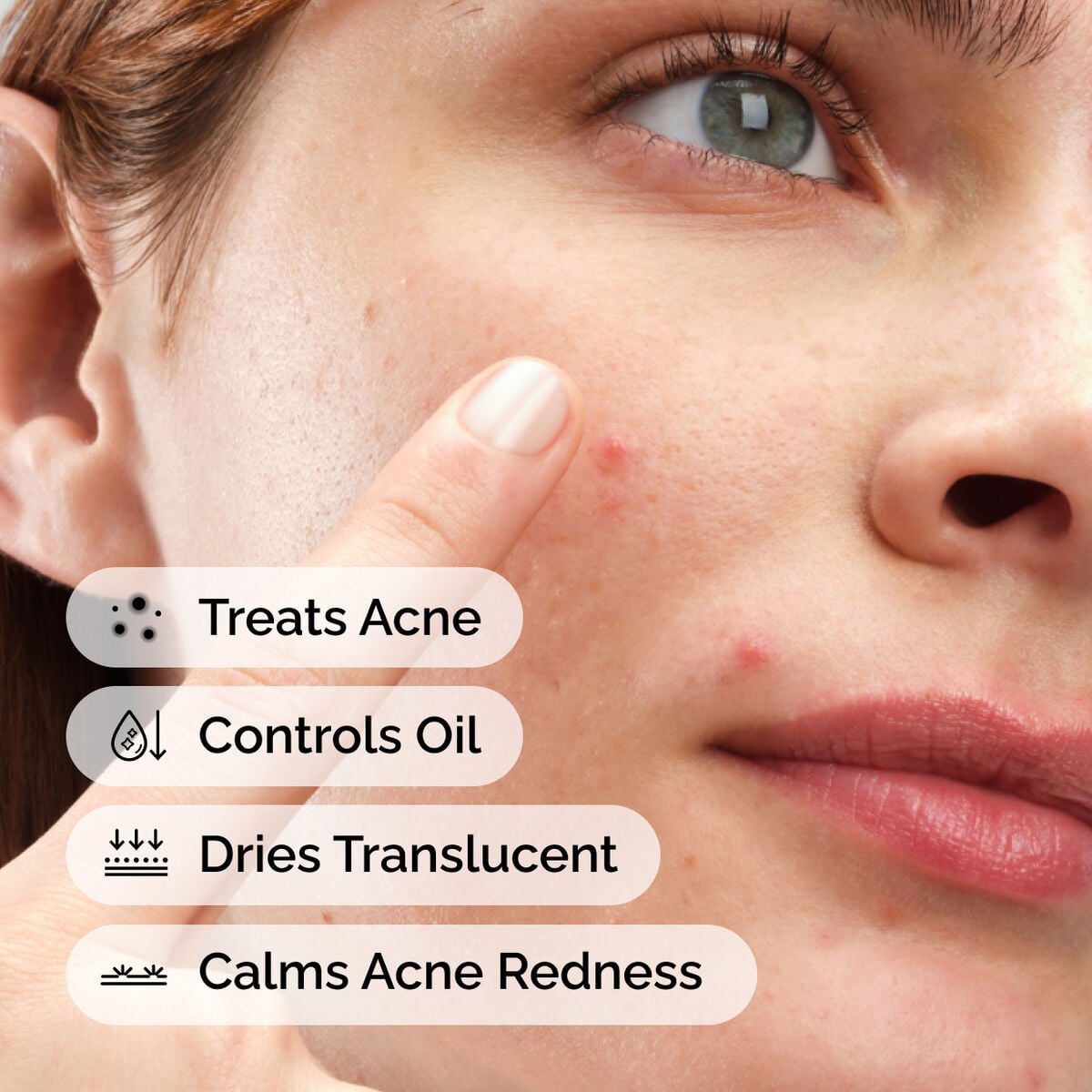 sulfur-10-powder-to-cream-concentrate-p7 ord-sulfur-10pct-powder-to-cream-concentrate-model-application-with-benefits-acne.jpg