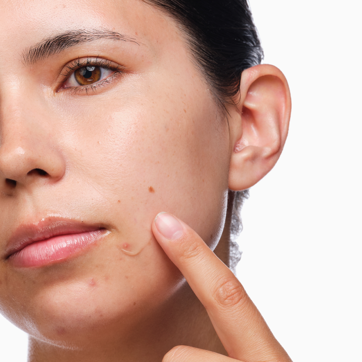 the-acne-set-o4 rdn-the-acne-set-application.png